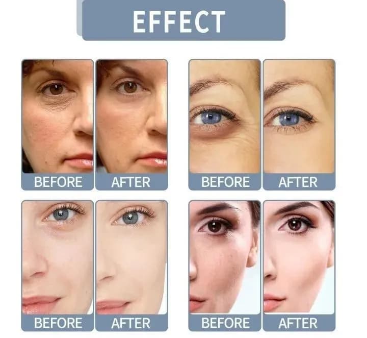 Fort Under Eye Dark Circle Removal Gel 30%