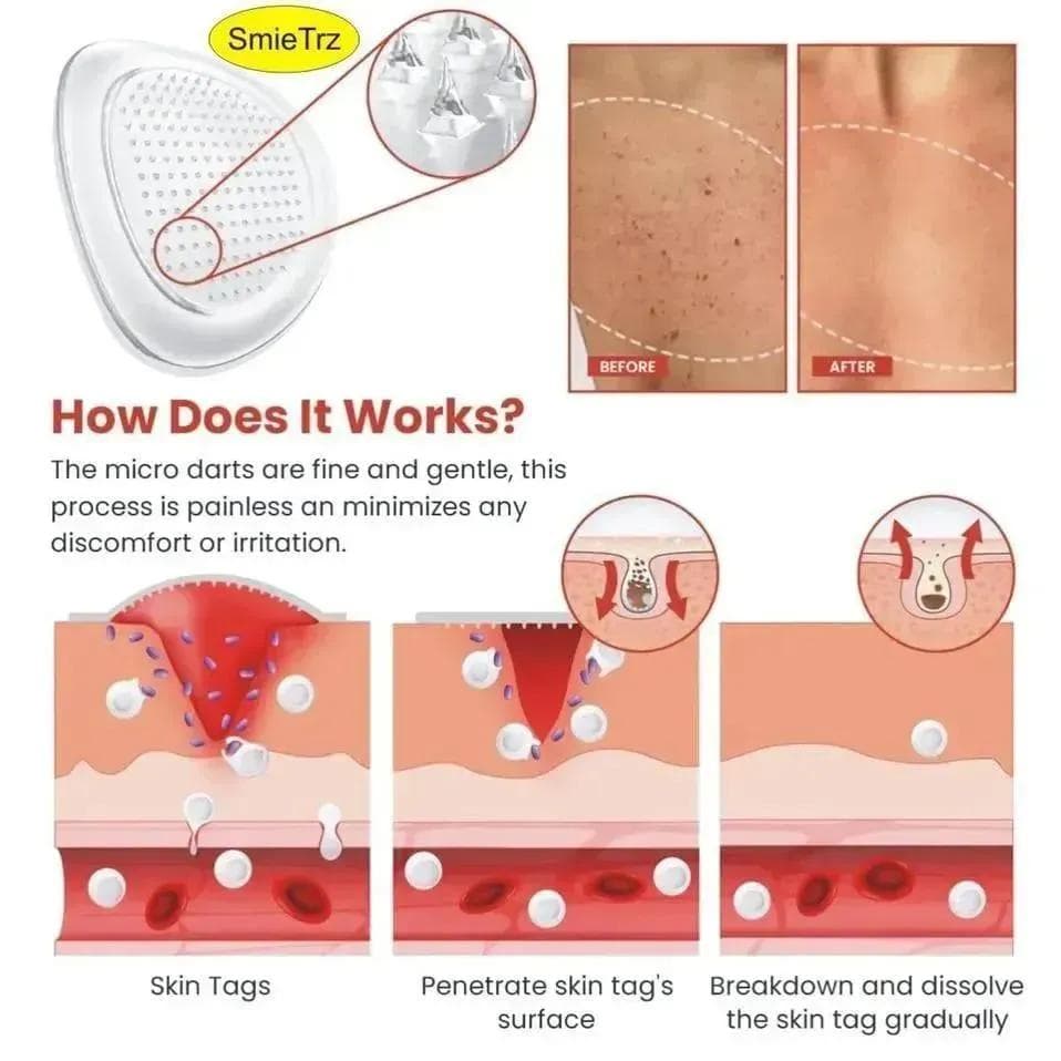 DermaSmooth Skin Tag Remover Patch 40 Pcs White